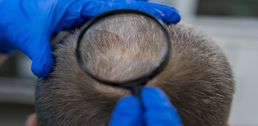 Greffe de Cheveux et Santé Capillaire